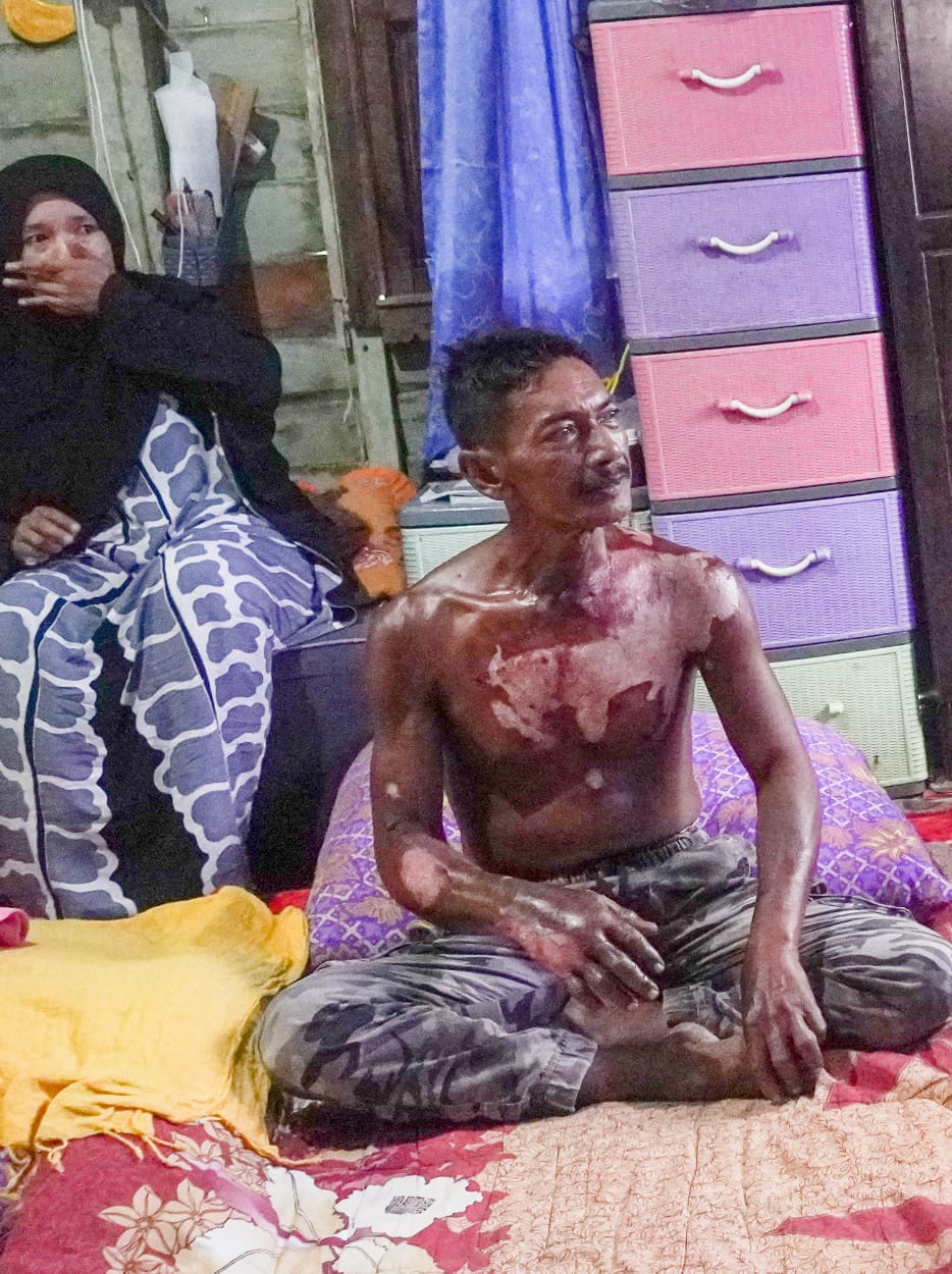 Nelayan Melecur Badan Terkena Air Enjin